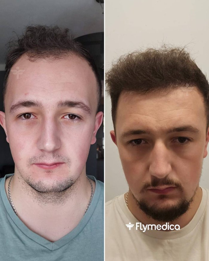 Vorher-Nachher-Zusammenstellung einer Haartransplantation bei einem Flymedica-Patienten