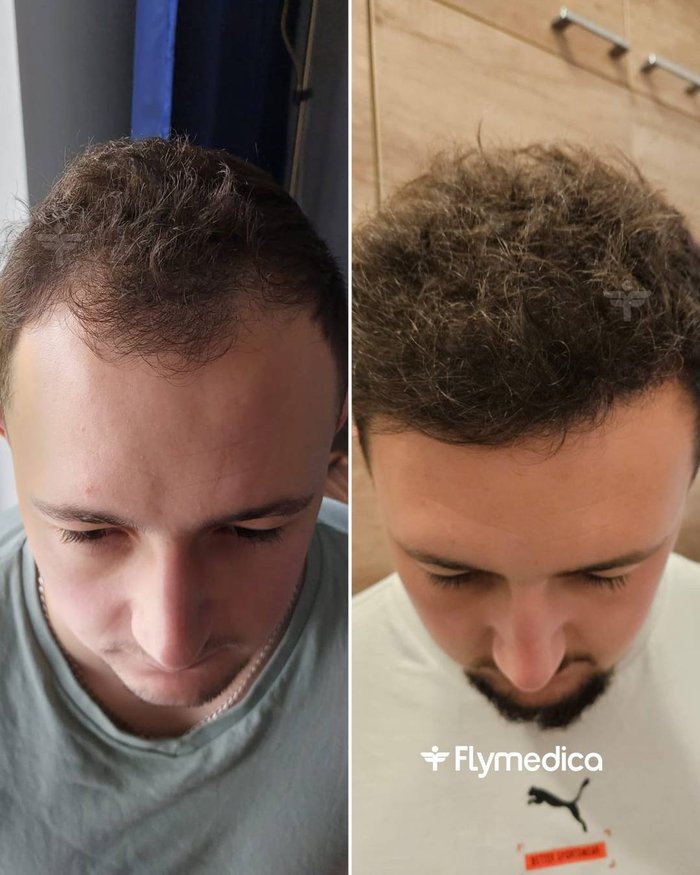 Vorher-Nachher-Zusammenstellung einer Haartransplantation bei einem Flymedica-Patienten
