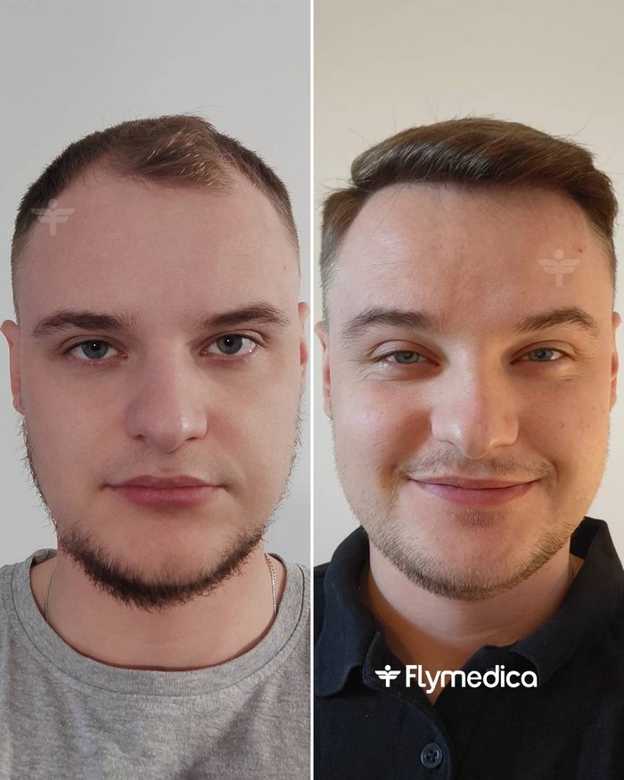 Vorher-Nachher-Zusammenstellung einer Haartransplantation bei einem Flymedica-Patienten
