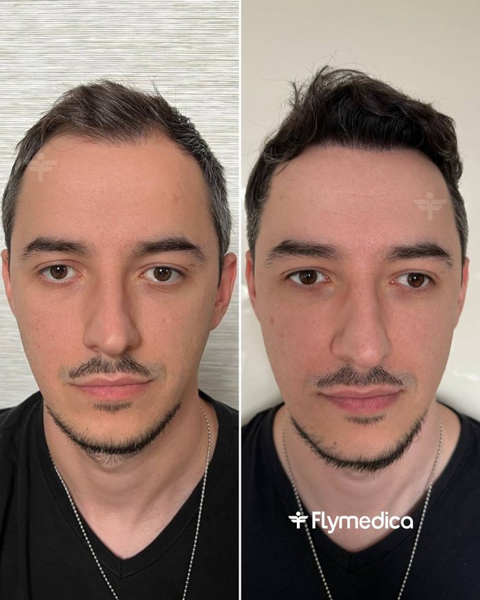 Vorher-Nachher-Zusammenstellung einer Haartransplantation bei einem Flymedica-Patienten