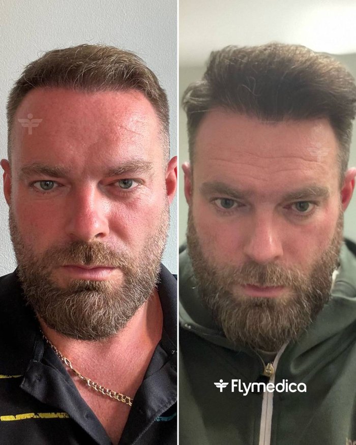 Vorher-Nachher-Zusammenstellung einer Haartransplantation bei einem Flymedica-Patienten