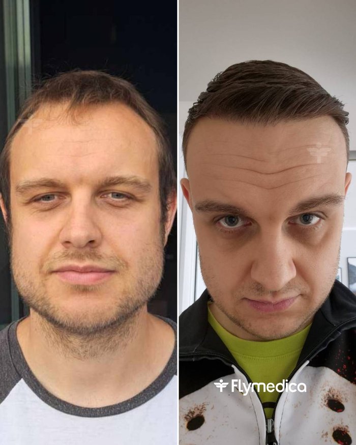 Vorher-Nachher-Zusammenstellung einer Haartransplantation bei einem Flymedica-Patienten