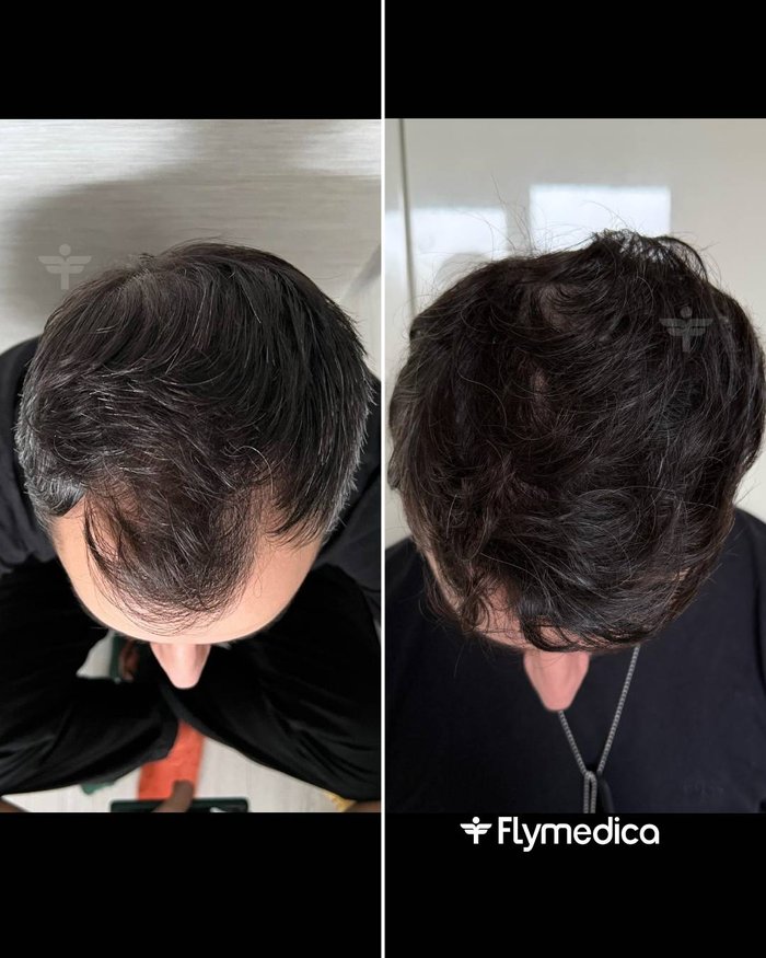 Vorher-Nachher-Zusammenstellung einer Haartransplantation bei einem Flymedica-Patienten