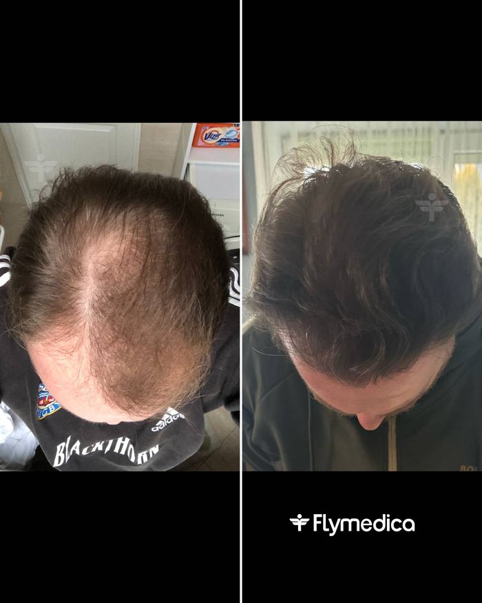 Vorher-Nachher-Zusammenstellung einer Haartransplantation bei einem Flymedica-Patienten
