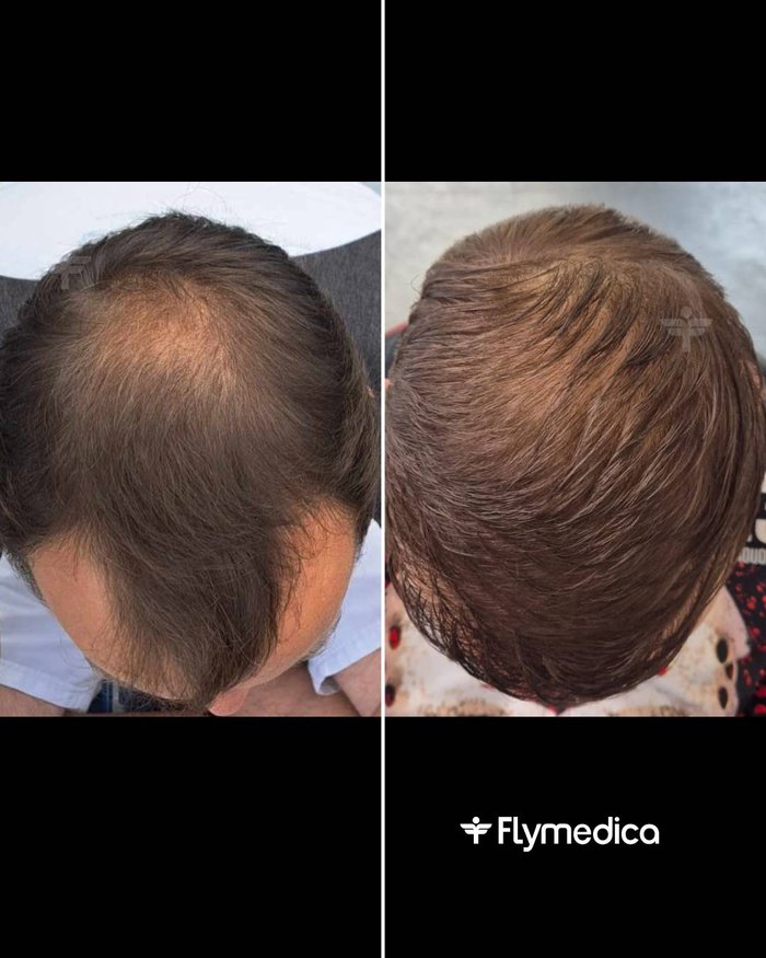 Vorher-Nachher-Zusammenstellung einer Haartransplantation bei einem Flymedica-Patienten