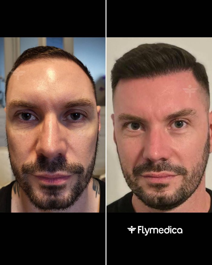 Vorher-Nachher-Zusammenstellung einer Haartransplantation bei einem Flymedica-Patienten
