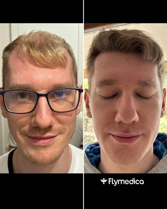 Vorher-Nachher-Zusammenstellung einer Haartransplantation bei einem Flymedica-Patienten