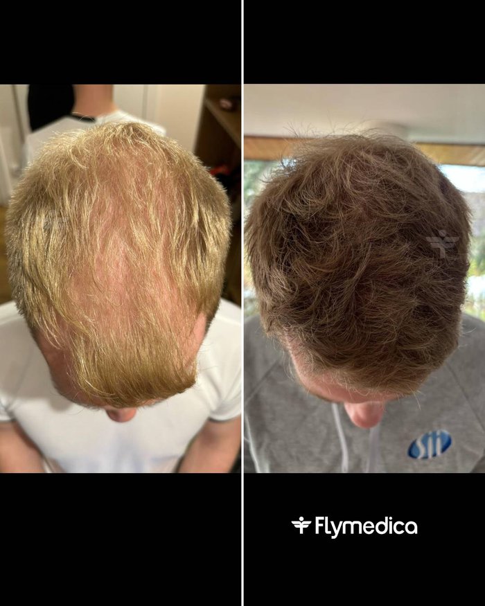Vorher-Nachher-Zusammenstellung einer Haartransplantation bei einem Flymedica-Patienten