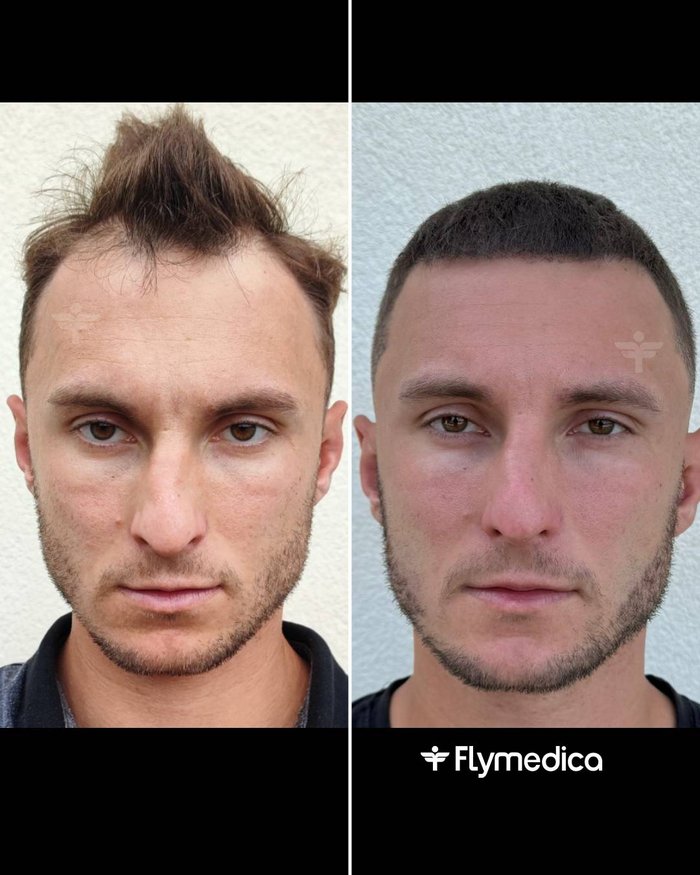 Vorher-Nachher-Zusammenstellung einer Haartransplantation bei einem Flymedica-Patienten