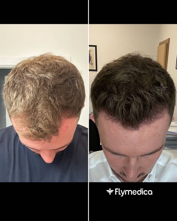 Vorher-Nachher-Zusammenstellung einer Haartransplantation bei einem Flymedica-Patienten
