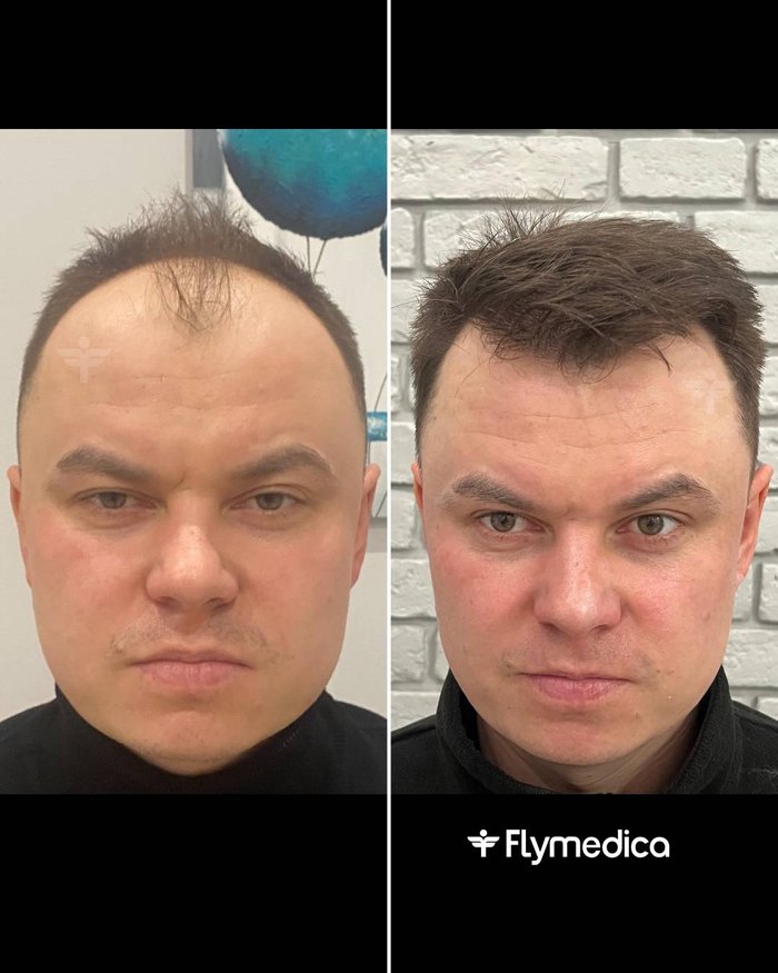 Vorher-Nachher-Zusammenstellung einer Haartransplantation bei einem Flymedica-Patienten