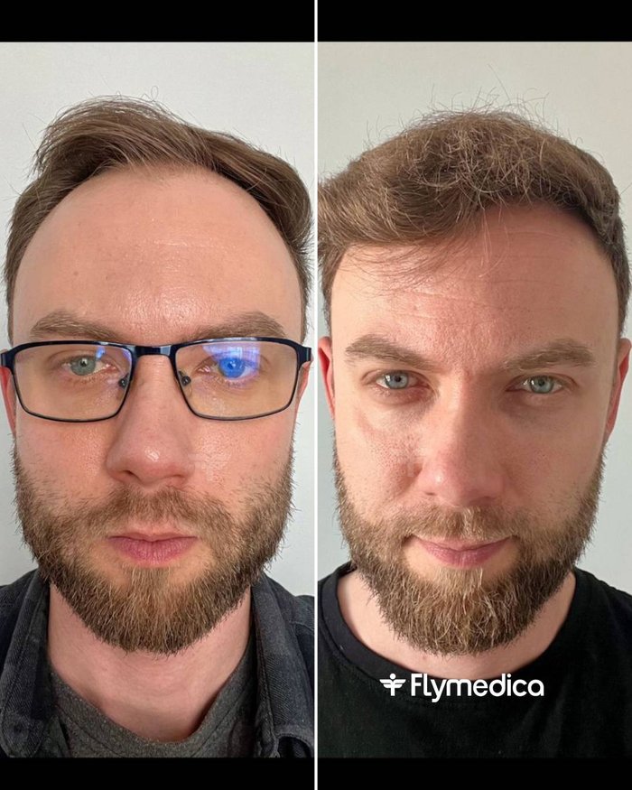 Vorher-Nachher-Zusammenstellung einer Haartransplantation bei einem Flymedica-Patienten