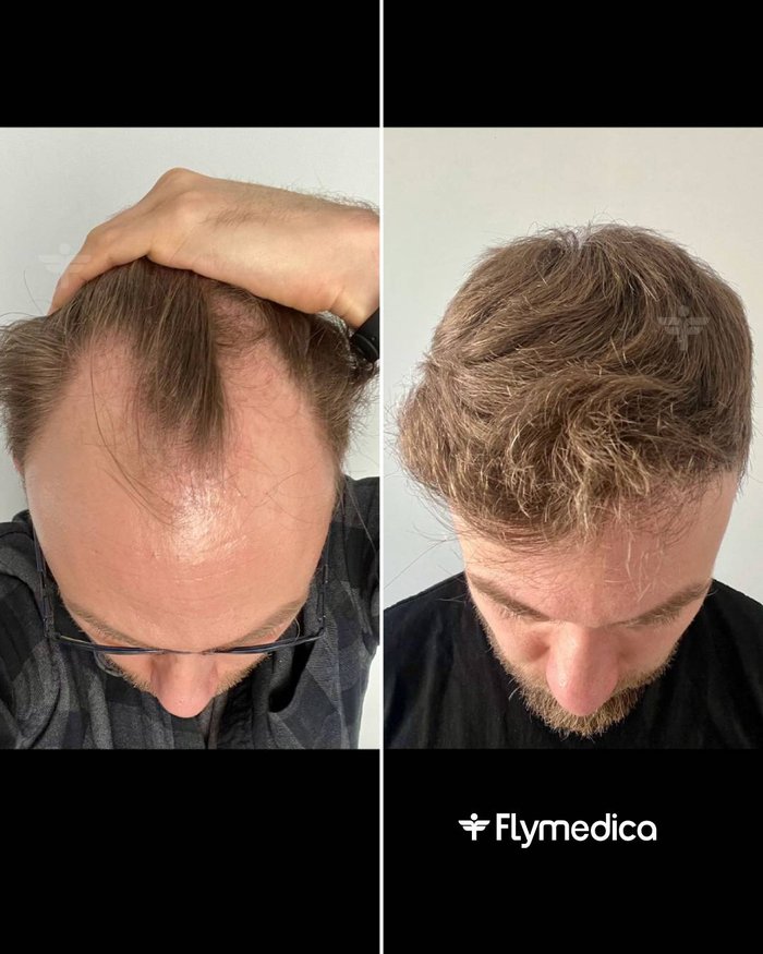 Vorher-Nachher-Zusammenstellung einer Haartransplantation bei einem Flymedica-Patienten