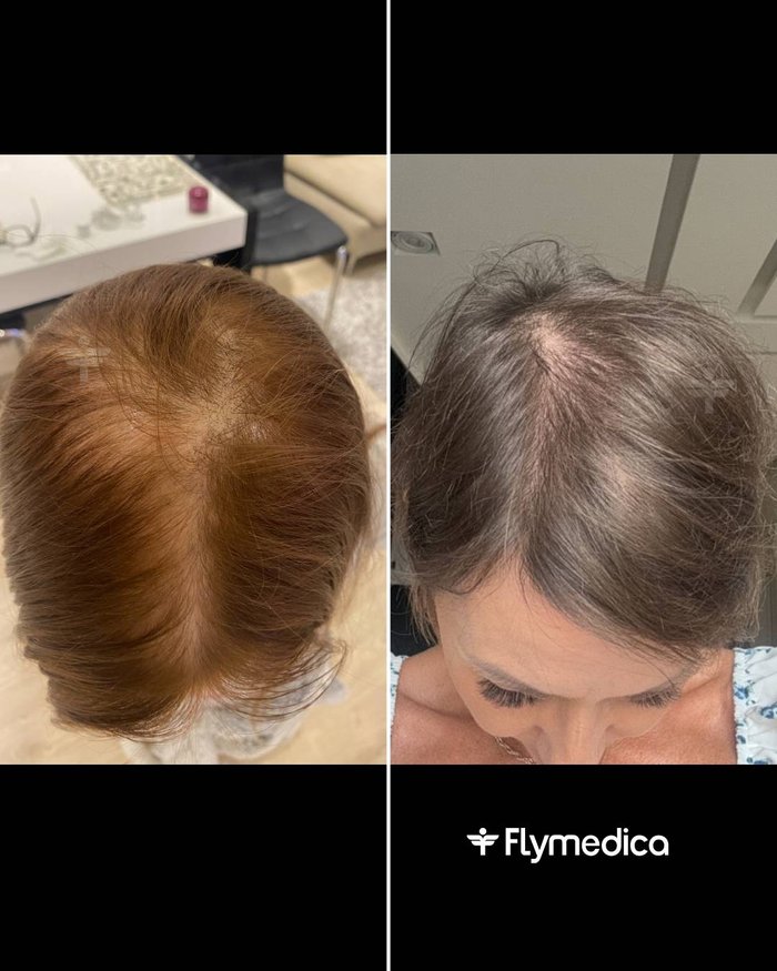 Vorher-Nachher-Zusammenstellung einer Haartransplantation bei einer Flymedica-Patientin