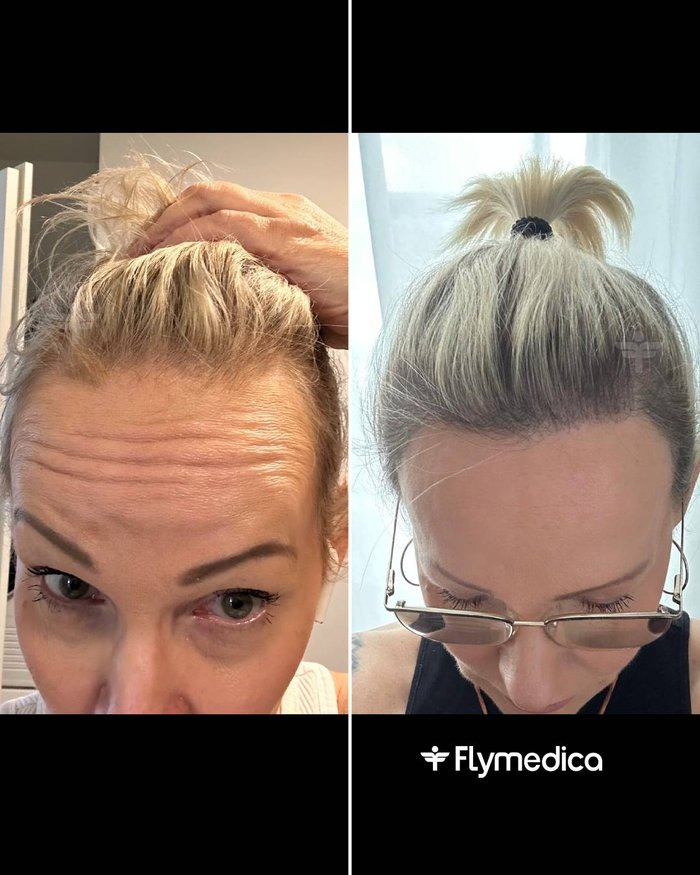 Vorher-Nachher-Zusammenstellung einer Haartransplantation bei einer Flymedica-Patientin