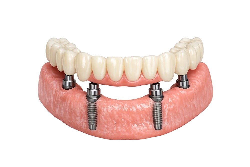 Modell eines Zahnbogens mit vier All-on-4-Implantaten und fester prothetischer Brücke