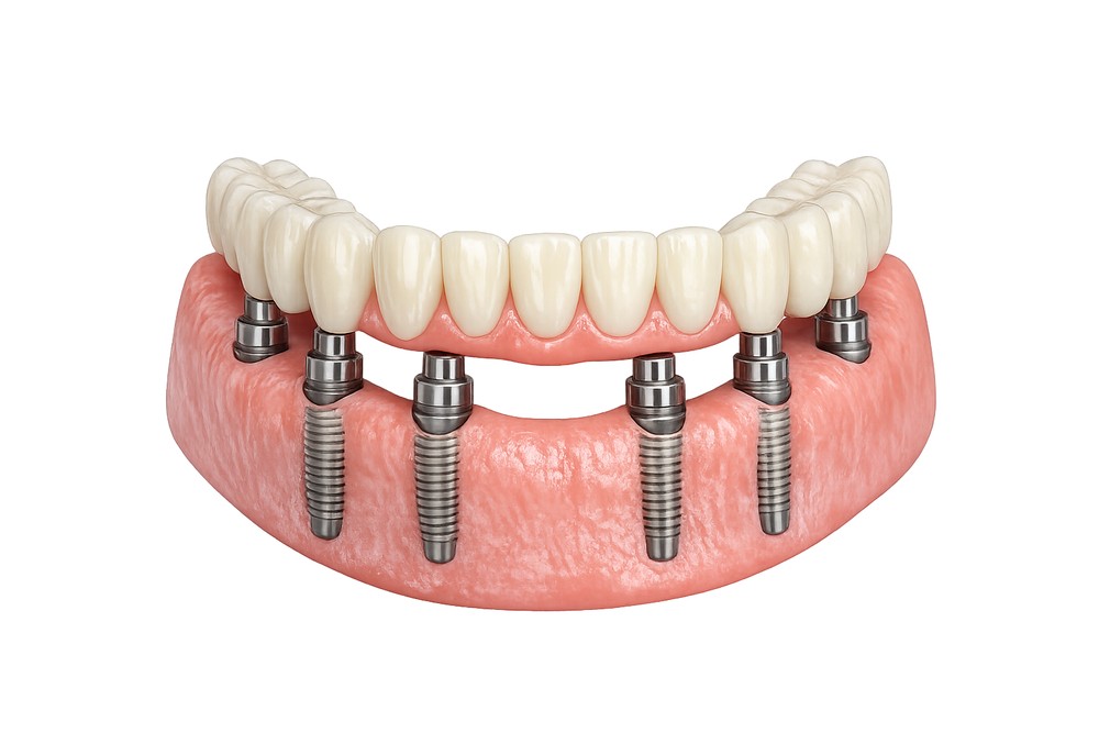 Modell eines Zahnbogens mit sechs All-on-6-Implantaten und fester prothetischer Brücke