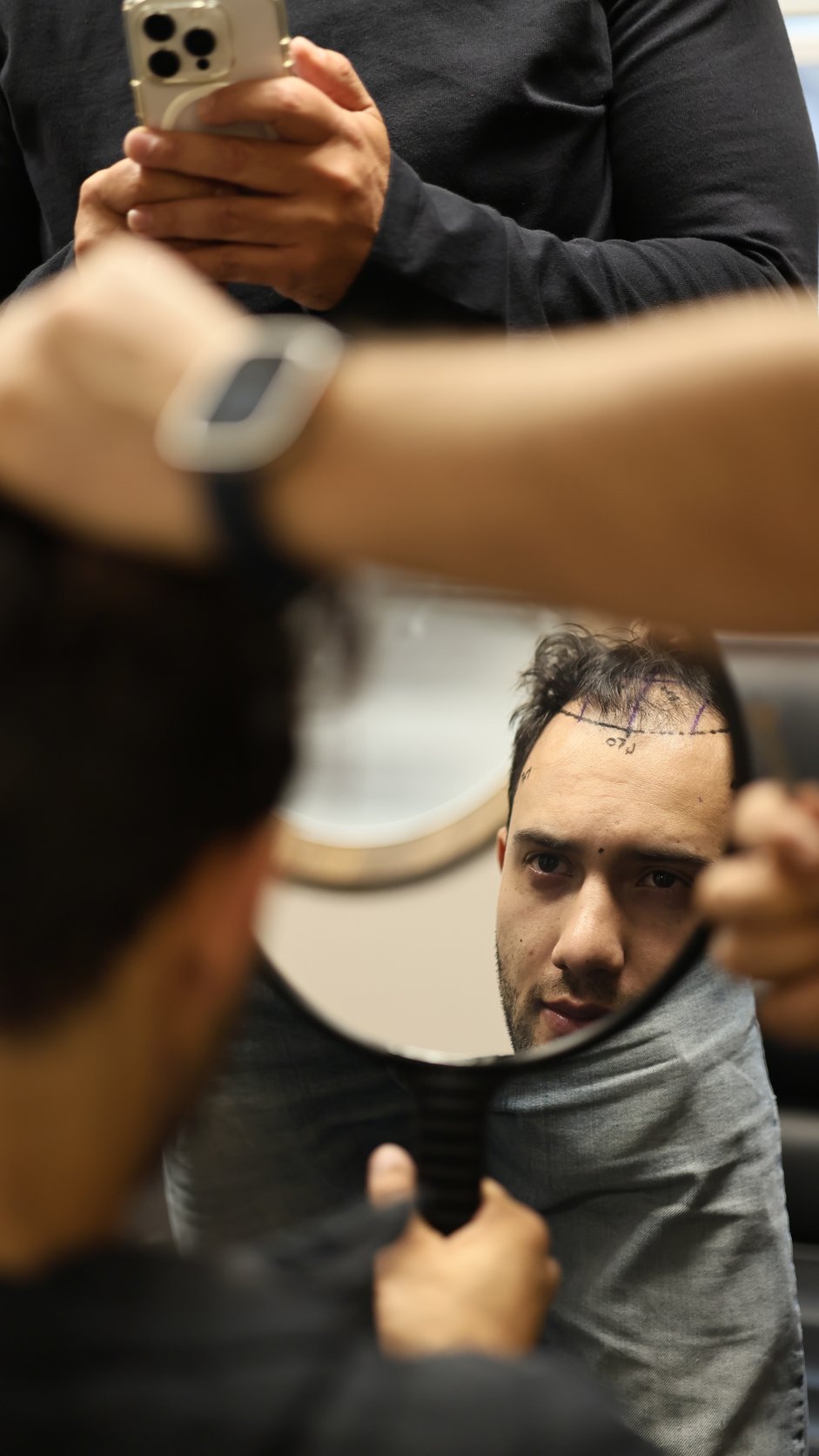 Vor dem Eingriff mit einem Marker eingezeichnete Haarlinie, Patient fotografiert sich im Spiegel