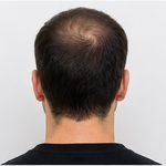 Beispielfoto: Spenderbereich am Hinterkopf