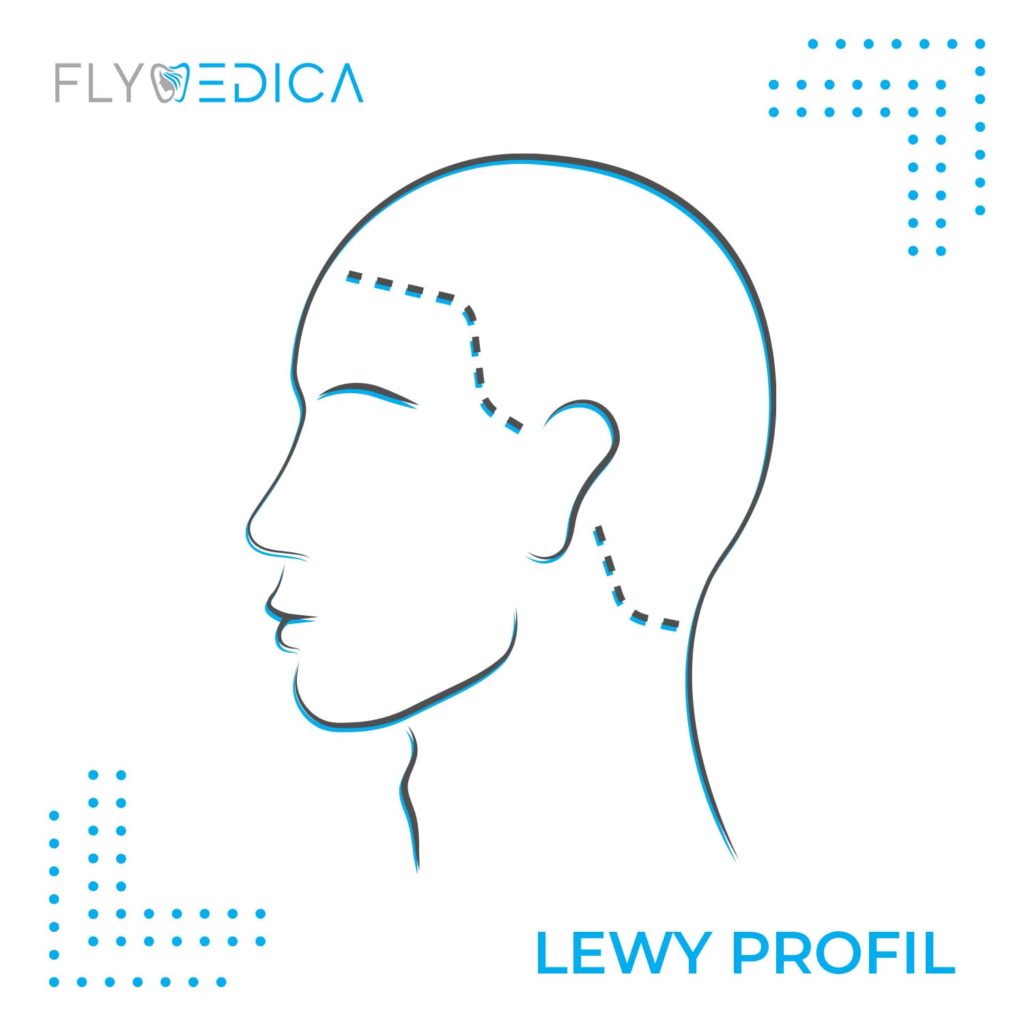 Lewy Profil