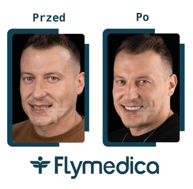 Hollywood Smile - licówki porcelanowe jako recepta na śnieżnobiały uśmiech 6 Hollywood Smile w Turcji z Flymedica - przed i po