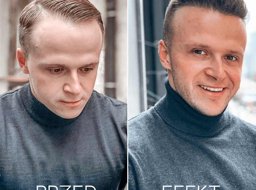 Łysienie androgenowe u kobiet i mężczyzn: połączenie terapii i nowe sposoby na leczenie wypadania włosów