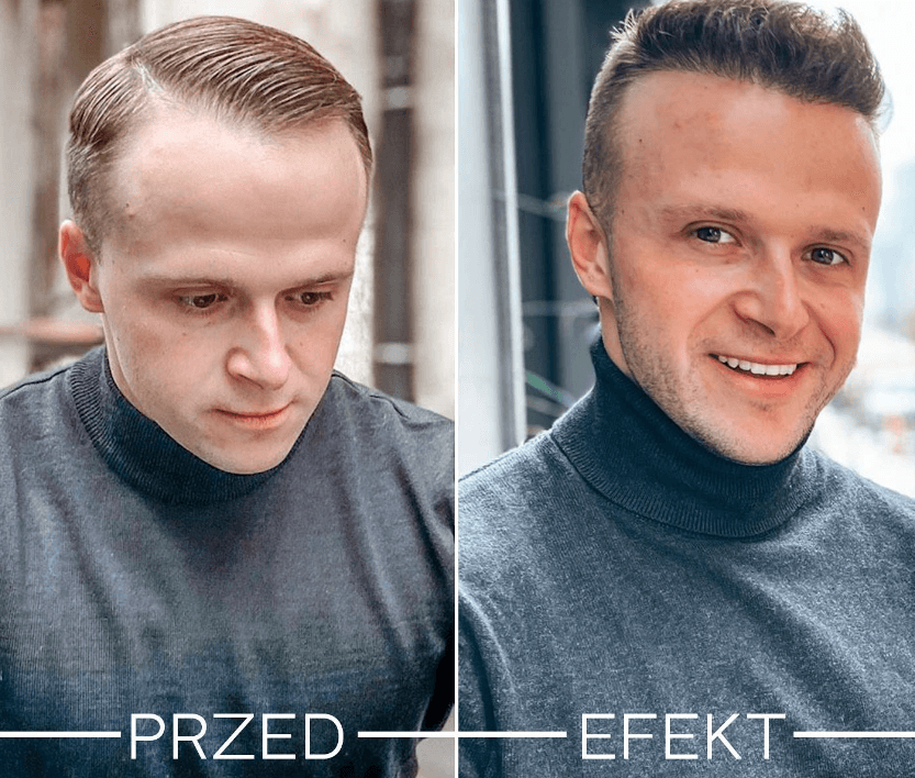 Łysienie androgenowe u kobiet i mężczyzn: połączenie terapii i nowe sposoby na leczenie wypadania włosów