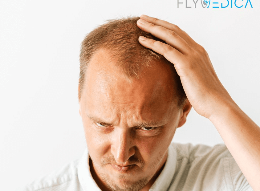 Wypadanie Włosów – Przyczyny, Leczenie, i Domowe Sposoby