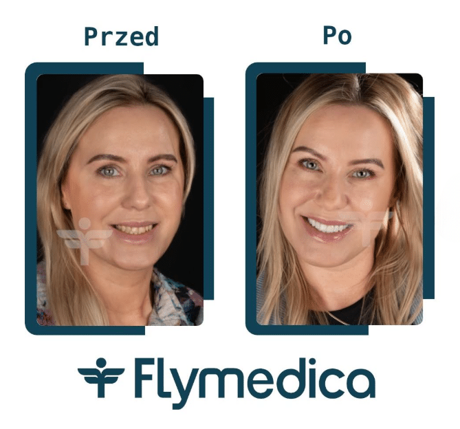Hollywood Smile - licówki porcelanowe jako recepta na śnieżnobiały uśmiech 3 Hollywood smile - licówki z Flymedica, efekt przed i po u kobiety