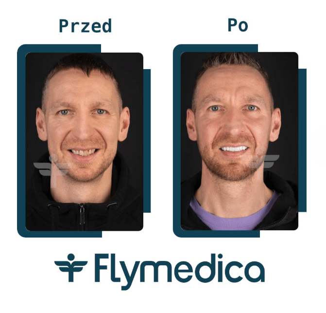 Hollywood Smile - licówki porcelanowe jako recepta na śnieżnobiały uśmiech 5 Hollywoodzki uśmiech z Flymedica, efekt przed i po
