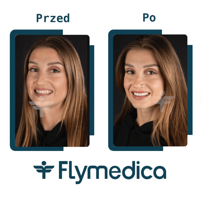 Hollywood Smile - licówki porcelanowe jako recepta na śnieżnobiały uśmiech 2 Naturalnie wyglądające licówki - Hollywood Smile z Flymedica