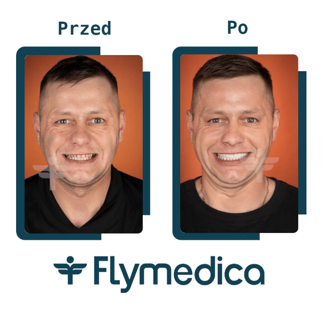 Hollywood Smile - licówki porcelanowe jako recepta na śnieżnobiały uśmiech 4 Uśmiech hollywoodzki z Flymedica - efekty po zabiegach