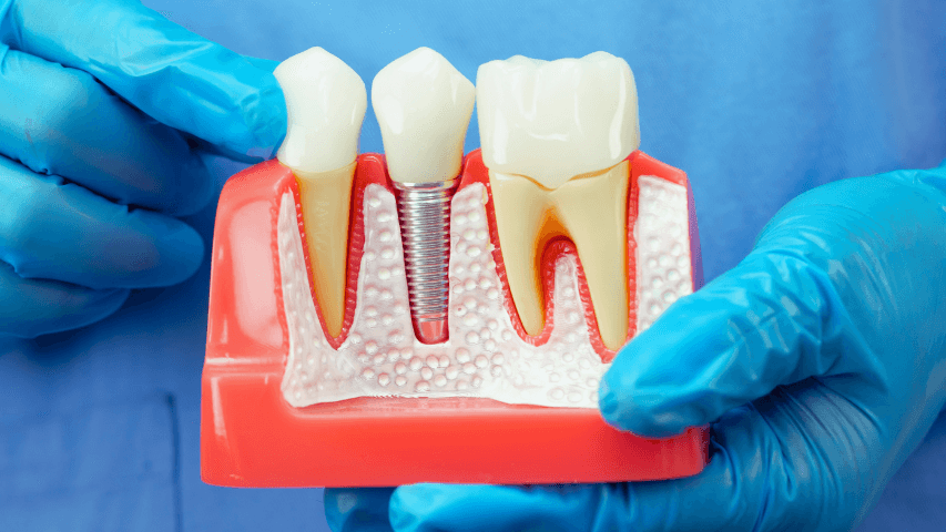 Odbudowa zęba – na czym polega i ile kosztuje