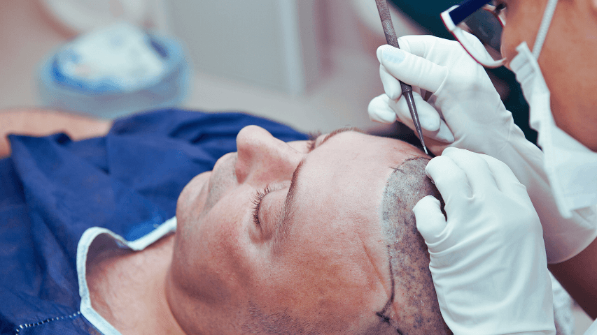 czy przeszczep włosów jest trwały