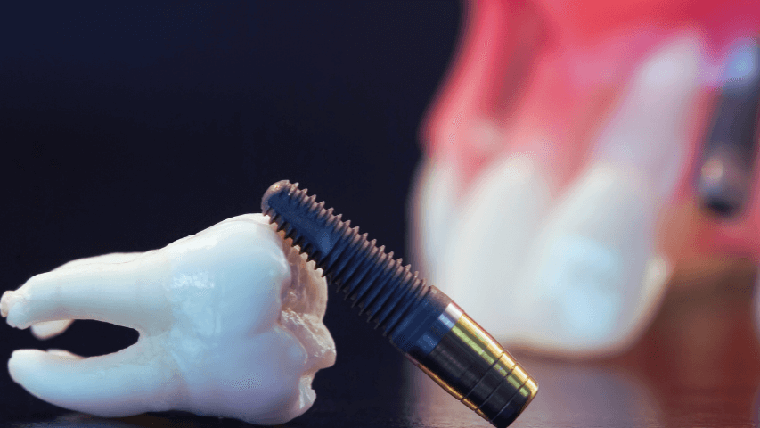 implanty zębowe w całej szczęce