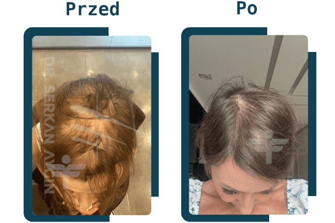 Przed i po - efekty przeszczepu włosów u kobiety wykonanego z Flymedica