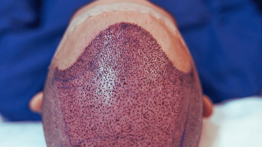 skóra głowy po przeszczepie