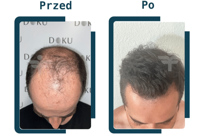 trwałość przeszczepu włosów