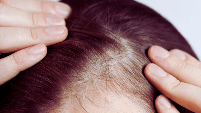 zabieg przeszczepu włosów kobiecy, wypadanie włosów